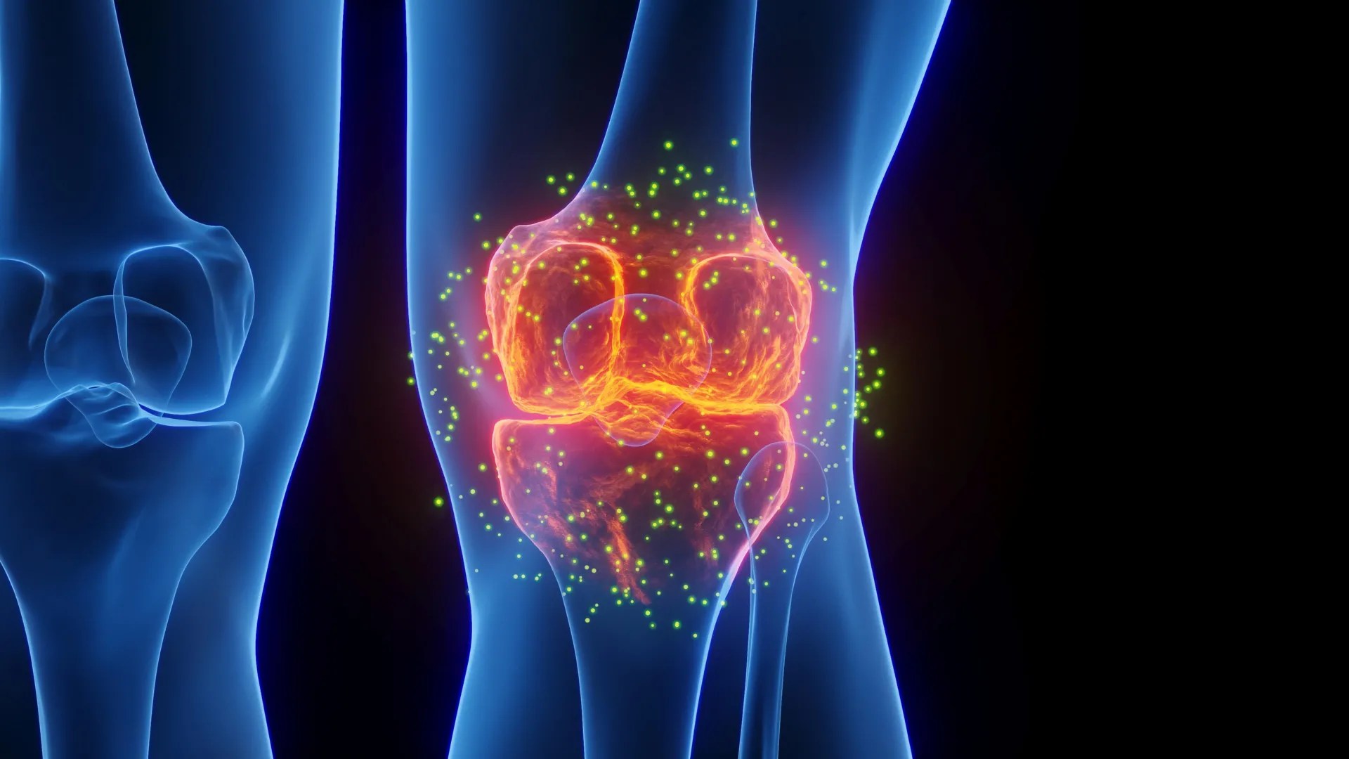 Epilepsy Drug and Hydrogel Reverses Cartilage Damage