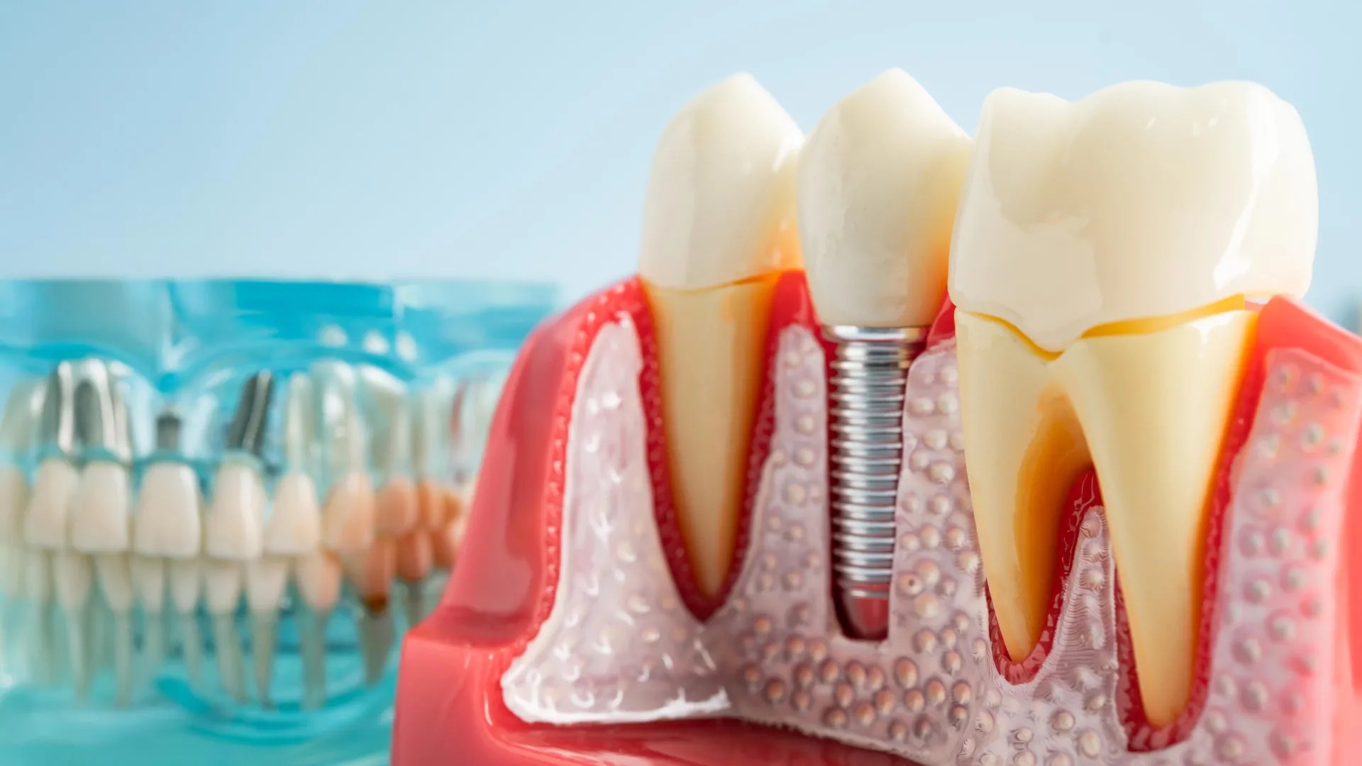 How corroding dental implants trigger chronic inflammation