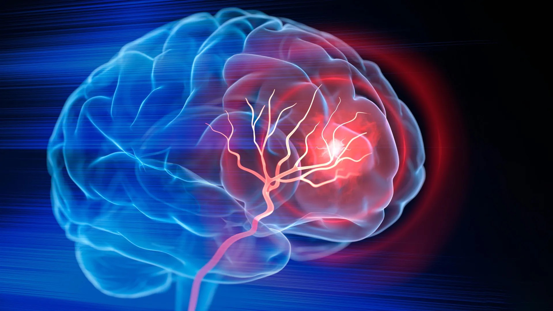 How the APOE4 gene damages brain blood vessels