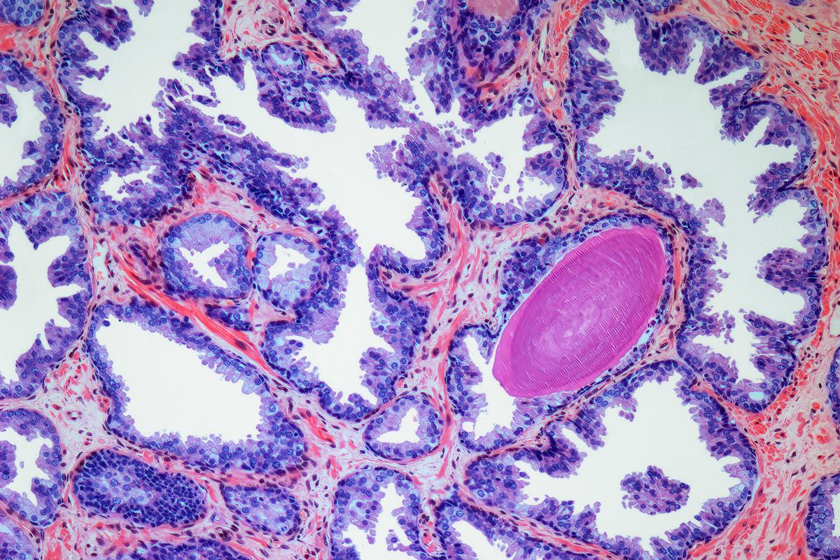 Why low-grade prostate cancer needs a new name